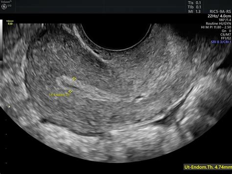 postmenopausal endometrial thickness on ultrasound